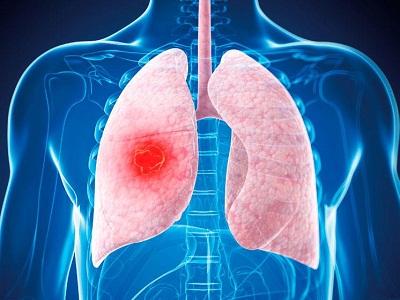 肺癌免疫治疗