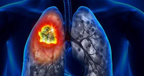 肺癌的早期症状是什么？做到早察觉、早发现、早治疗！