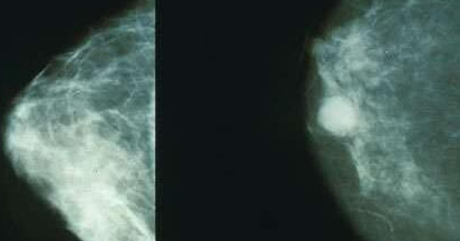 好消息：医学家将有望开发出治疗三阴性乳腺癌的新疗法！