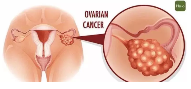 尼拉帕尼治疗卵巢癌的效果如何？