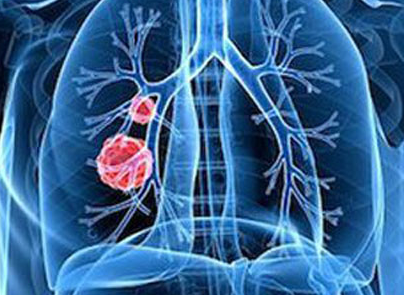 治疗肺癌的紫杉类药物是什么？
