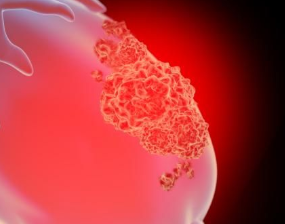 四大治疗卵巢癌的药物是什么？