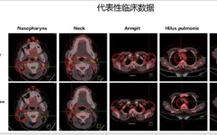CD7-CAR-T细胞疗法的临床试验取得新进展!!