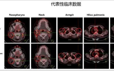 CD7-CAR-T细胞疗法的临床试验取得新进展！！