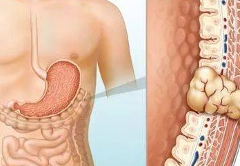Avapritinib成为治疗胃肠道间质瘤（GIST）的神药？